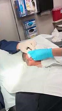 Dr. B Shows Large Cyst Removal on Face (part 2) #dermatology #cyst #cystremoval