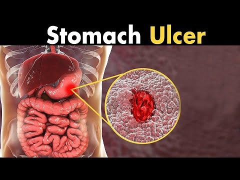 What causes a stomach ulcer?