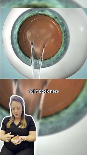 EVO ICL - Implantable Contact Lens