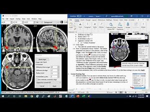 Intro to Lesion Drawing with MRIcron Part1