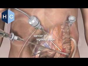 Laparoscopic Minimally Invasive Colon Surgery - Dr. Eric Haas