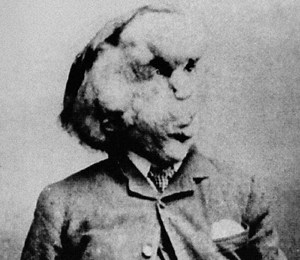 The tragic true story of Elephant Man, Joseph Merrick