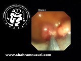 Clip Closure Piecemeal EMR Colon Polyp Resection • Video • MEDtube.net