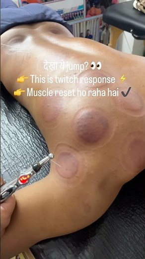 Healing in action series (Day 23) Dry needling for infraspinatus muscle