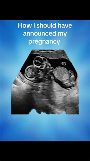 How many babies do you see? Today I’m 33 weeks 4 days!🤰This ultrasound picture is from my 1st high risk apt. when I was 14 weeks pregnant. It was when they confirmed we were having mono mono twins (share the same placenta & same sac). 👶🏼👶🏼 They said it was too much to go into at that apt. so the next apt. is when they talked to me about all the risks with this type of rare pregnancy. #momotwins #twinpregnancy #twinpregnancyjourney