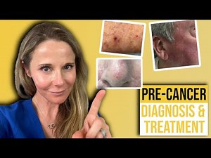 Actinic keratosis treatment guide from a Dermatologist