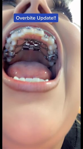 Loving these results! #overbite #overbitecorrection #braces #bracesoff #bracestips #orthodontist #bentist #MicroRaveWithRoni #results #update