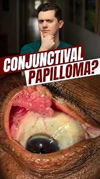 Conjunctival Papilloma Treatment #parkercornea #drphilipdockery #ophthalmology #conjunctival