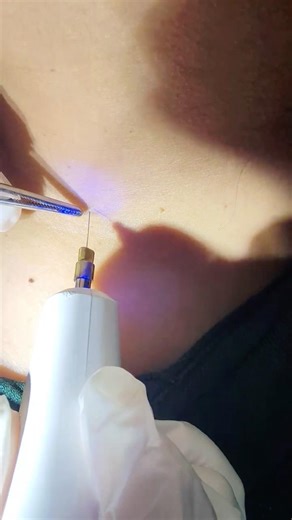 SkinTag/Acrochordons Removal by Electrosurgery #skin #skincare #electeosurgery #fyp #doctor #md