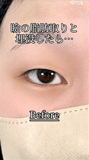 【二重整形】瞼の脂肪取りと埋没したら…#shorts