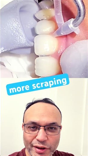 Painless Teeth Cleaning 😳 Airflow System #dentalstudents #dentist #youtubeshorts