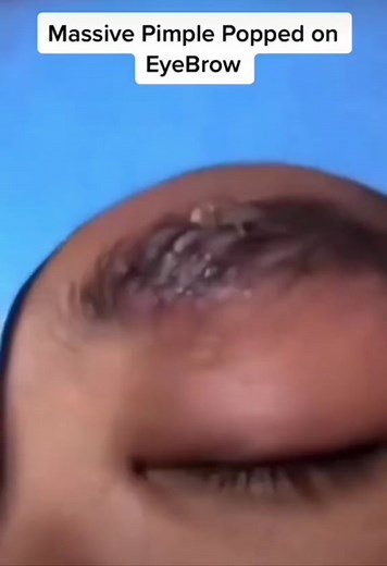 Eyebrow pimple EXPLOSION 😱 #pimple #pimplepop #pimpleexplosion #gross #fyp