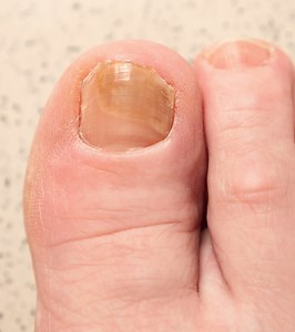 Hydrogen Peroxide For Toenail Fungus: 4 Easy Home Remedies