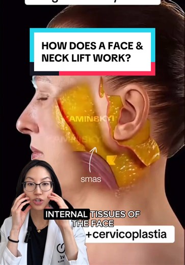 🧐 Ever wondered what actually happens during a face and neck lift surgery? This detailed animation breaks down where incisions are typically made and which areas are adjusted during surgery. ✨While I don’t use this exact technique, it offers a helpful visual insight into the overall procedure. #plasticsurgeon #surgerytok #plasticsurgery #facelift #aesthetics #BeautyTok #beautytrends