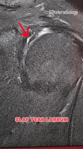 S9TELERADIOLOGY on Instagram: "SLAP (Superior Labrum Anterior to Posterior) tear involves injury to the superior glenoid labrum at the biceps anchor. Key MRI Findings (MR Arthrogram > MRI): Linear fluid signal extending into the superior labrum Irregularity or detachment of the labrum from the glenoid Abnormal signal at the long head of biceps anchor Associated paralabral cysts (suggest chronicity) Imaging Tips: Best seen on coronal oblique and axial sequences Differentiate from normal variants