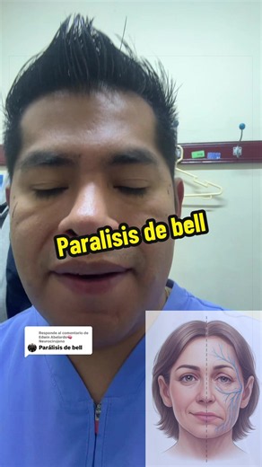 Parálisis facial periférica (Parálisis de Bell): qué es y rehabilitación