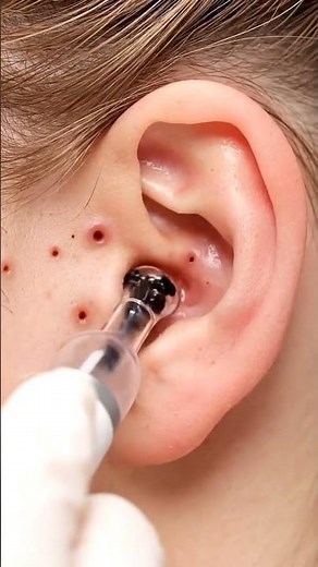 Satisfying Behind Ear Pore Cleaning | Clinical ASMR #satisfying #blackheadcaique #viral #reels #fyp