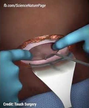 Parto por cesarea paso a paso