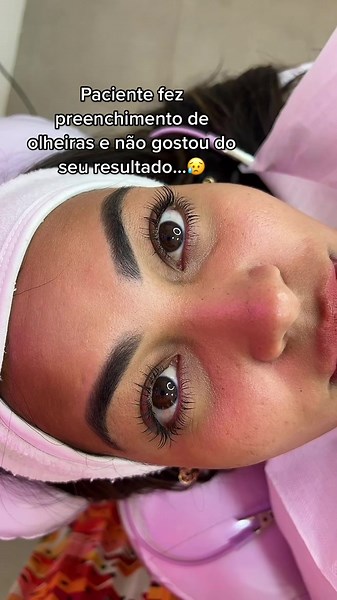 Problemas com o preenchimento de olheiras: O que fazer?