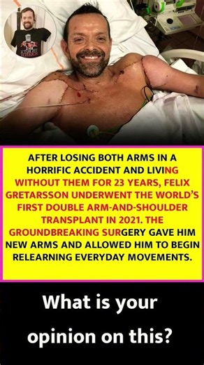 FELIX GRETARSSON RECEIVES WORLD’S FIRST DOUBLE ARM TRANSPLANT
