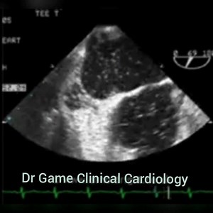 PFO Bubble Study - Contrast - TEE - Echo Clip #PFO #Cardiology #Mayoclinic #Anatomy #Echocardiography #Echo | Clinical Cardiology by DocTor Game