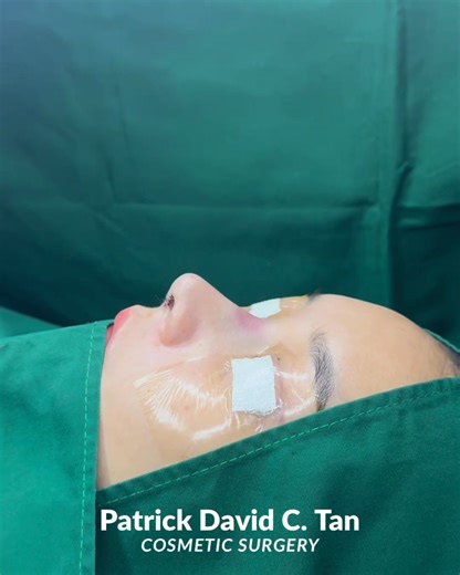 👃 Bulbous Nose? Let’s Talk Solutions. A bulbous nose—characterized by a rounded, wide nasal tip—is a common concern, especially among Asian patients. Often caused by thick skin or weak lower cartilages, this tip shape can make the nose appear larger or undefined. 🔍 The Solution? Open Structural Rhinoplasty. By reinforcing and reshaping the nasal framework (often with cartilage grafts), structural rhinoplasty creates a more refined, natural-looking tip—without sacrificing function or stability.