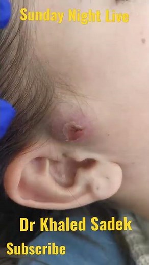 super juicy #cystremoval Dr Khaled Sadek. #blackheads