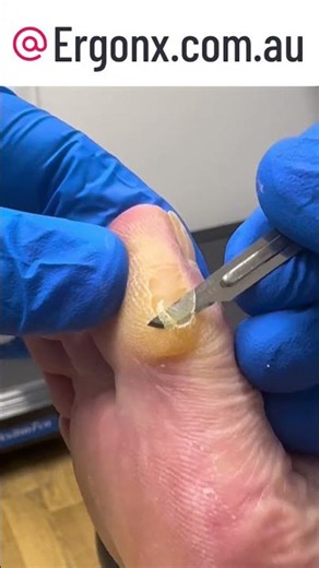 Podiatry Clinic: Watch a Big Toe Callus Cut with a Scalpel for Amazing Results #FootCare #Podiatry