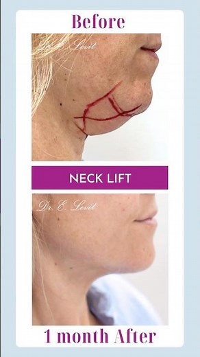 Neck lift. Before & After.