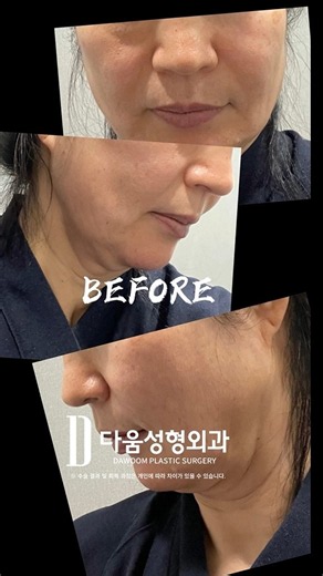 턱뼈 윤곽 싹 드러난 브이리프트 전후 비교 #shorts