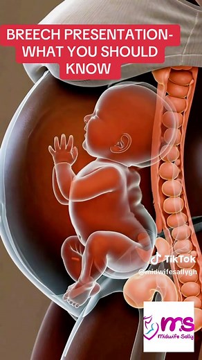 Understanding Breech Birth: What to Expect