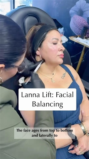 Watch Until The End To See This Lanna Lift Transformation #injectables #radiesse #naturalresults