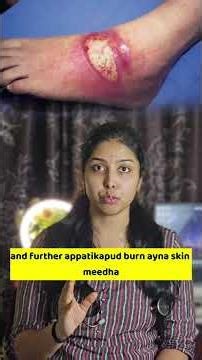 🔥 Burns in Children: Stop Using Toothpaste! 🔥|| Dr. Konjeti Hampi || #skincare #information #inform