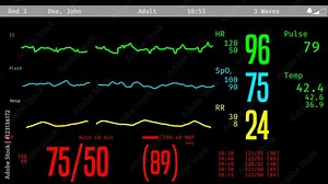 ICU screen monitoring dying patient, vital signs dropping, clinical death Stock Video