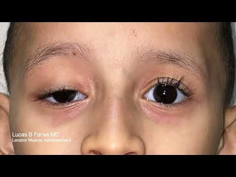 Congenital Ptosis Repair - Levator Muscle Advancement