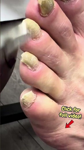 Part 1: Cutting Extremely Thick Diabetic Toenails | Oddly Satisfying Foot Care #satisfyingshorts