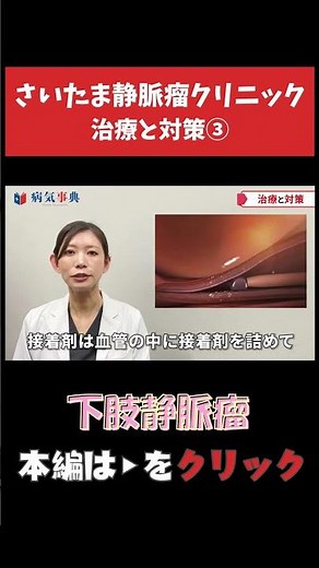【下肢静脈瘤】治療と対策③ #下肢静脈瘤 #足がつる #こむら返り