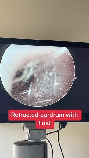 Patient with a retracted ear drum and fluid (effusion). See how the eardrum looks sucked in? This is from blocked eustachian tubes not allowing proper equalization of the ears. When the patient swallows, you can see the fluid moving! #ent #eustachiantubedysfunction #eustachiantube #earpop #reddysinus #effusion