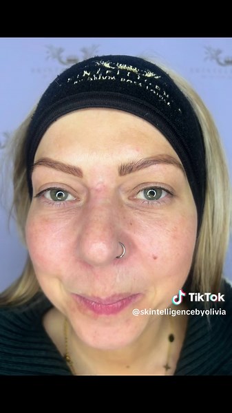 Benefits of CoolJet Plasma for Ingrown Hairs and Skin Rejuvenation