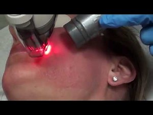 What will I look like after a Fraxel laser treatment?