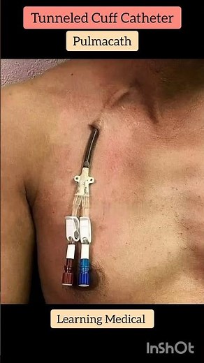 Tunneled cuff catheter | Pulmacath | dialysis catheter