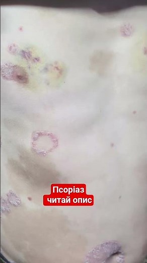 Псоріаз — це хронічне запальне захворювання, яке прискорює цикл оновлення клітин шкіри. .🔎
