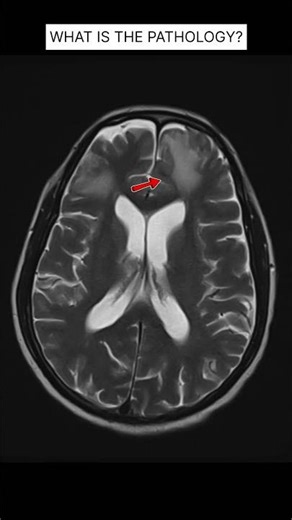 MRI Brain T2 Multiple Lesions What’s the Diagnosis #shorts
