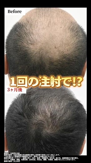 一回の注射で発毛実感！？#発毛 #広島 #湘南agaクリニック広島院 #薄毛治療 #毛根再生注射#育毛
