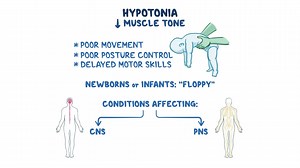 Video: Approach to hypotonia (newborn and infant): Clinical sciences - Video Explanation! | Osmosis | Osmosis