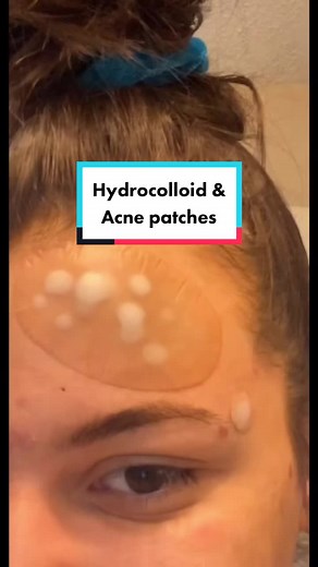 Understanding Hydrocolloid & Acne Patches for Skin Sunday Routine