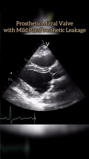 Prosthetic Mitral Valve #echocardiogram #echo Echocardiography For Beginners