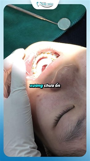 Attaching a Lingual Retainer After Braces Removal | Dr. Yen