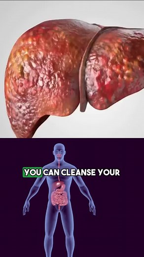 NATURAL RECIPE TO CLEANSE YOUR LIVER. #liverhealth #liver #liverdisease #fattyliver #health #liverdetox #livercleanse #detox #healthylifestyle #cirrhosis #fattyliverdisease #nafld #nutrition #healthyeating #guthealth #nash #hepatitis #healthyliver #wellness #nafldwarrior #livertransplant #fattyliverdiet #nafldfoods #nafldfighter #lowsodium #fattyliverjourney #healthyeats #lowsodiumlife #lowsodiumfood