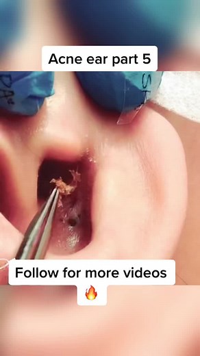 Huge hidden acne inside ear #acne #acneshot #pimple #cyst Follow is for more videos